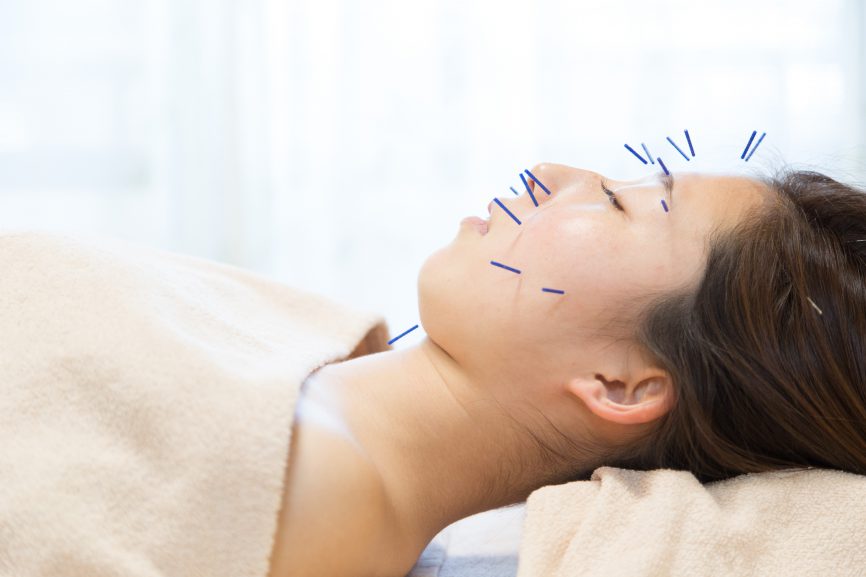 美容針(美容鍼)小顔　