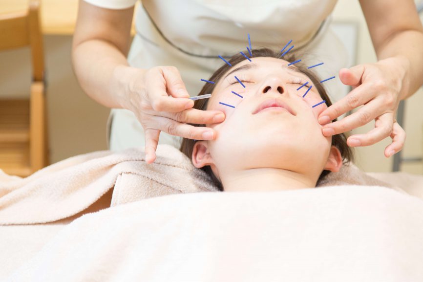 美容鍼している途中の写真