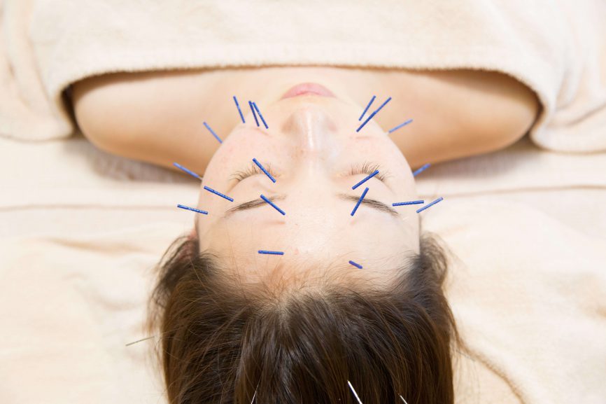 美容針(美容鍼)小顔　